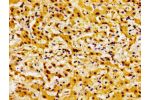 Immunohistochemistry of paraffin-embedded human liver cancer using CSB-PA892353LA01HU at dilution of 1:100