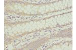 Immunohistochemistry of paraffin-embedded human colon cancer using CSB-PA892446DSR1HU at dilution 1:100