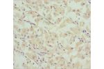 Immunohistochemistry of paraffin-embedded human gastric cancer using CSB-PA892453ESR1HU at dilution 1:100