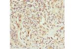 Immunohistochemistry of paraffin-embedded human bladder cancer using CSB-PA892453ESR2HU at dilution 1:100