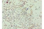 Immunohistochemistry of paraffin-embedded human breast cancer using CSB-PA892479ESR1HU at dilution 1:100