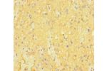 Immunohistochemistry of paraffin-embedded human glioma cancer using CSB-PA892496LA01HU at dilution of 1:100
