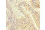 Immunohistochemistry of paraffin-embedded human colon cancer using CSB-PA896481ESR1HU at dilution of 1:100
