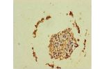 Immunohistochemistry of paraffin-embedded human breast cancer using CSB-PA896481LA01HU at dilution 1:100