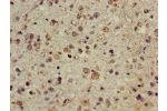Immunohistochemistry of paraffin-embedded human glioma cancer using CSB-PA896685LA01HU at dilution of 1:100