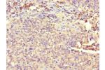 Immunohistochemistry of paraffin-embedded human cervical cancer using CSB-PA896697LA01HU at dilution of 1:100