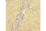 Immunohistochemistry of paraffin-embedded human liver cancer using CSB-PA896722LA01HU at dilution of 1:100