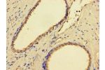 Immunohistochemistry of paraffin-embedded human prostate cancer using CSB-PA896740LA01HU at dilution of 1:100