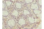 Immunohistochemistry of paraffin-embedded human colon cancer using CSB-PA896752ESR2HU at dilution 1:100