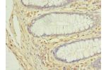 Immunohistochemistry of paraffin-embedded human colon cancer using CSB-PA896759LA01HU at dilution of 1:100
