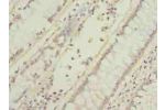 Immunohistochemistry of paraffin-embedded human colon cancer using CSB-PA897089LA01HU at dilution of 1:100