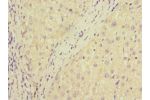 Immunohistochemistry of paraffin-embedded human liver cancer CSB-PA897321ESR1HU at dilution 1:100