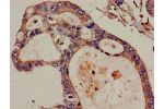 Immunohistochemistry of paraffin-embedded human pancreatic cancer using CSB-PA897532LA01HU at dilution of 1:100