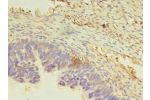 Immunohistochemistry of paraffin-embedded human ovarian cancer using CSB-PA897549LA01HU at dilution of 1:100