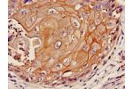 Immunohistochemistry of paraffin-embedded human cervical cancer using CSB-PA897579LA01HU at dilution of 1:100