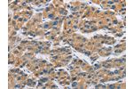 The image on the left is immunohistochemistry of paraffin-embedded Human liver cancer tissue using CSB-PA898117(CERK Antibody) at dilution 1/30, on the right is treated with fusion protein. (Original magnification: 