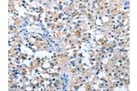 The image on the left is immunohistochemistry of paraffin-embedded Human thyroid cancer tissue using CSB-PA898565(ASB2 Antibody) at dilution 1/50, on the right is treated with fusion protein. (Original magnification: 