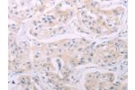 The image on the left is immunohistochemistry of paraffin-embedded Human breast cancer tissue using CSB-PA898784(ADCY7 Antibody) at dilution 1/60, on the right is treated with synthetic peptide. (Original magnification: 