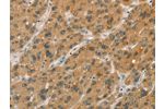 The image on the left is immunohistochemistry of paraffin-embedded Human liver cancer tissue using CSB-PA898841(CYP11A1 Antibody) at dilution 1/50, on the right is treated with fusion protein. (Original magnification: 