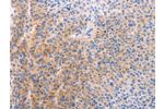 The image on the left is immunohistochemistry of paraffin-embedded Human liver cancer tissue using CSB-PA899511(ADHFE1 Antibody) at dilution 1/60, on the right is treated with synthetic peptide. (Original magnification: 