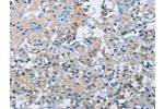 The image on the left is immunohistochemistry of paraffin-embedded Human thyroid cancer tissue using CSB-PA899996(BTN2A2 Antibody) at dilution 1/50, on the right is treated with fusion protein. (Original magnification: 