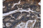 The image on the left is immunohistochemistry of paraffin-embedded Human colon cancer tissue using CSB-PA900410(DHCR7 Antibody) at dilution 1/20, on the right is treated with fusion protein. (Original magnification: 