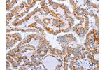 The image on the left is immunohistochemistry of paraffin-embedded Human thyroid cancer tissue using CSB-PA900594(DTX2 Antibody) at dilution 1/15, on the right is treated with fusion protein. (Original magnification: 