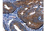 The image on the left is immunohistochemistry of paraffin-embedded Human cervical cancer tissue using CSB-PA900881(FOXJ1  Antibody) at dilution 1/13, on the right is treated with synthetic peptide. (Original magnification: 