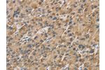 The image on the left is immunohistochemistry of paraffin-embedded Human liver cancer tissue using CSB-PA900926(DDIT4L Antibody) at dilution 1/20, on the right is treated with fusion protein. (Original magnification: 