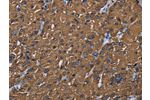 The image on the left is immunohistochemistry of paraffin-embedded Human liver cancer tissue using CSB-PA901137(BMP3 Antibody) at dilution 1/20, on the right is treated with synthetic peptide. (Original magnification: 