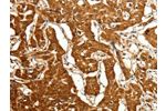 The image on the left is immunohistochemistry of paraffin-embedded Human lung cancer tissue using CSB-PA901428(CDH23 Antibody) at dilution 1/80, on the right is treated with fusion protein. (Original magnification: 