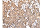 The image on the left is immunohistochemistry of paraffin-embedded Human breast cancer tissue using CSB-PA901585(ADAMTS1 Antibody) at dilution 1/30, on the right is treated with synthetic peptide. (Original magnification: 