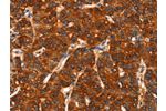 The image on the left is immunohistochemistry of paraffin-embedded Human liver cancer tissue using CSB-PA901875(DHH Antibody) at dilution 1/25, on the right is treated with synthetic peptide. (Original magnification: 