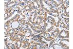 The image on the left is immunohistochemistry of paraffin-embedded Human thyroid cancer tissue using CSB-PA902603(ARL11 Antibody) at dilution 1/30, on the right is treated with fusion protein. (Original magnification: 
