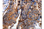 The image on the left is immunohistochemistry of paraffin-embedded Human colon cancer tissue using CSB-PA902732(EPCAM Antibody) at dilution 1/25, on the right is treated with synthetic peptide. (Original magnification: 