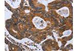 The image on the left is immunohistochemistry of paraffin-embedded Human colon cancer tissue using CSB-PA902740(GH2 Antibody) at dilution 1/40, on the right is treated with fusion protein. (Original magnification: 
