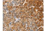 The image on the left is immunohistochemistry of paraffin-embedded Human liver cancer tissue using CSB-PA903031(CD200R1 Antibody) at dilution 1/60, on the right is treated with fusion protein. (Original magnification: 