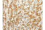 The image on the left is immunohistochemistry of paraffin-embedded Human gastic cancer tissue using CSB-PA903141(ERG Antibody) at dilution 1/30, on the right is treated with fusion protein. (Original magnification: 