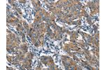 The image on the left is immunohistochemistry of paraffin-embedded Human gastic cancer tissue using CSB-PA903339(CHMP1A Antibody) at dilution 1/60, on the right is treated with fusion protein. (Original magnification: 