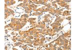 The image on the left is immunohistochemistry of paraffin-embedded Human breast cancer tissue using CSB-PA903364(ADAMTS18 Antibody) at dilution 1/30, on the right is treated with fusion protein. (Original magnification: 