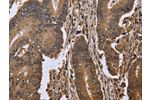 The image on the left is immunohistochemistry of paraffin-embedded Human colon cancer tissue using CSB-PA903985(EIF3H Antibody) at dilution 1/50, on the right is treated with fusion protein. (Original magnification: 