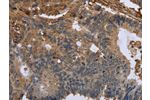 The image on the left is immunohistochemistry of paraffin-embedded Human colon cancer tissue using CSB-PA904028(FLNA Antibody) at dilution 1/50, on the right is treated with fusion protein. (Original magnification: 