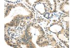 The image on the left is immunohistochemistry of paraffin-embedded Human thyroid cancer tissue using CSB-PA904266(BOK(BH3 domain) Antibody) at dilution 1/35, on the right is treated with synthetic peptide.