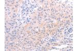 The image on the left is immunohistochemistry of paraffin-embedded Human lung cancer tissue using CSB-PA904437(AMH Antibody) at dilution 1/30, on the right is treated with synthetic peptide. (Original magnification: 