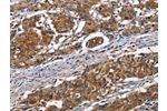 The image on the left is immunohistochemistry of paraffin-embedded Human gastic cancer tissue using CSB-PA904637(ATP7A  Antibody) at dilution 1/50, on the right is treated with synthetic peptide. (Original magnification: 