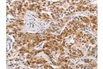 The image on the left is immunohistochemistry of paraffin-embedded Human prostate cancer tissue using CSB-PA904720(CABLES1 Antibody) at dilution 1/15, on the right is treated with fusion protein. (Original magnification: 