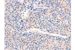 The image on the left is immunohistochemistry of paraffin-embedded Human liver cancer tissue using CSB-PA904906(AIMP2 Antibody) at dilution 1/25, on the right is treated with synthetic peptide. (Original magnification: 