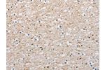 The image on the left is immunohistochemistry of paraffin-embedded Human brain tissue using CSB-PA905307(ARHGAP1 Antibody) at dilution 1/25, on the right is treated with fusion protein. (Original magnification: 