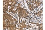 The image on the left is immunohistochemistry of paraffin-embedded Human gastic cancer tissue using CSB-PA905465(COL7A1 Antibody) at dilution 1/25, on the right is treated with synthetic peptide. (Original magnification: 