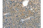 The image on the left is immunohistochemistry of paraffin-embedded Human liver cancer tissue using CSB-PA905549(CRLF2 Antibody) at dilution 1/60, on the right is treated with synthetic peptide. (Original magnification: 